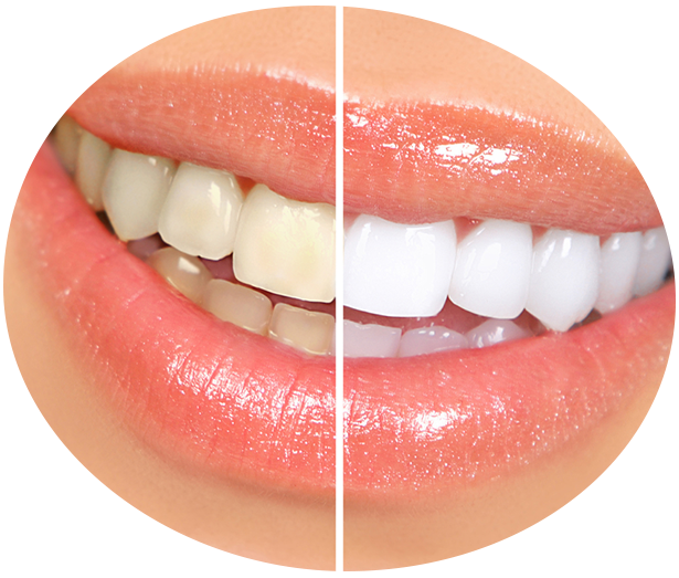 service whitening