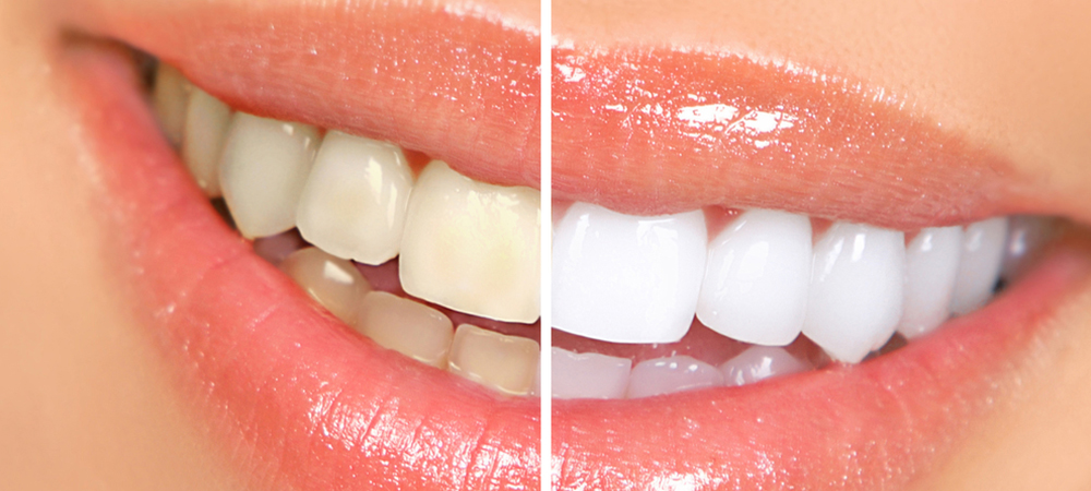 service whitening