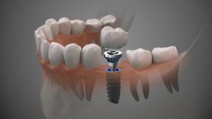 Dental Implants Price Comparison procedure albany