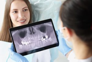 does a cracked tooth need to be pulled xray albany