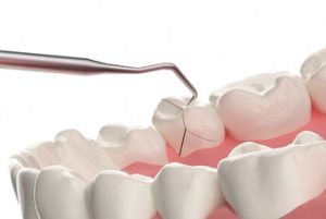 Hairline Cracks In Teeth assessment albany