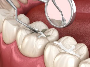 Root Canal Tooth Cracked procedure albany